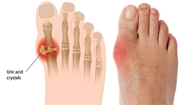 Điều trị bệnh gout với nấm linh chi