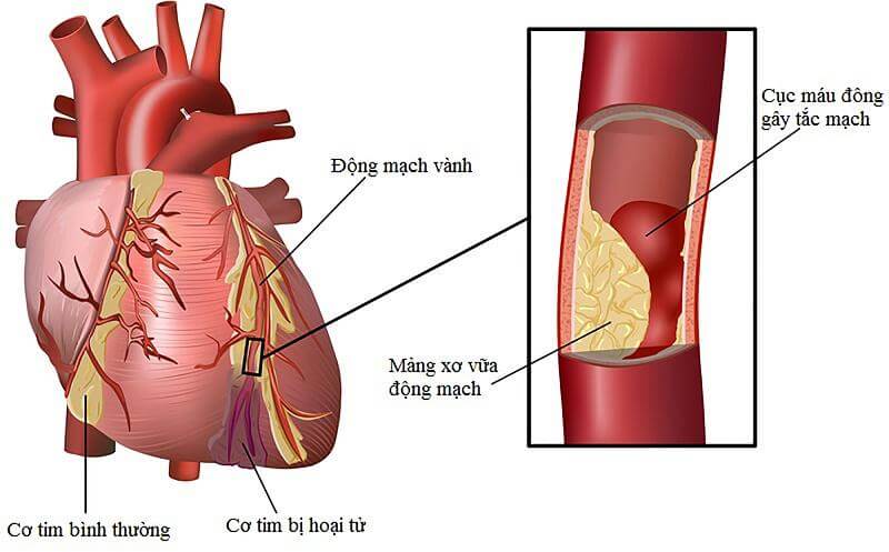 tác dụng nấm linh chi với bệnh tim mạch