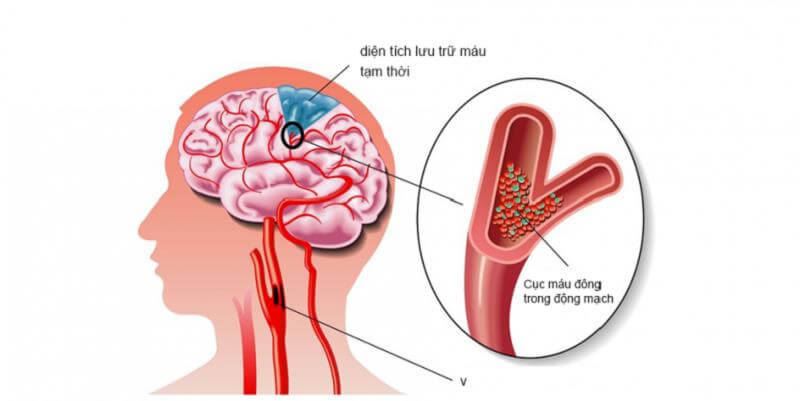 Tác dụng nấm linh chi với bệnh tai biến mạch máu não