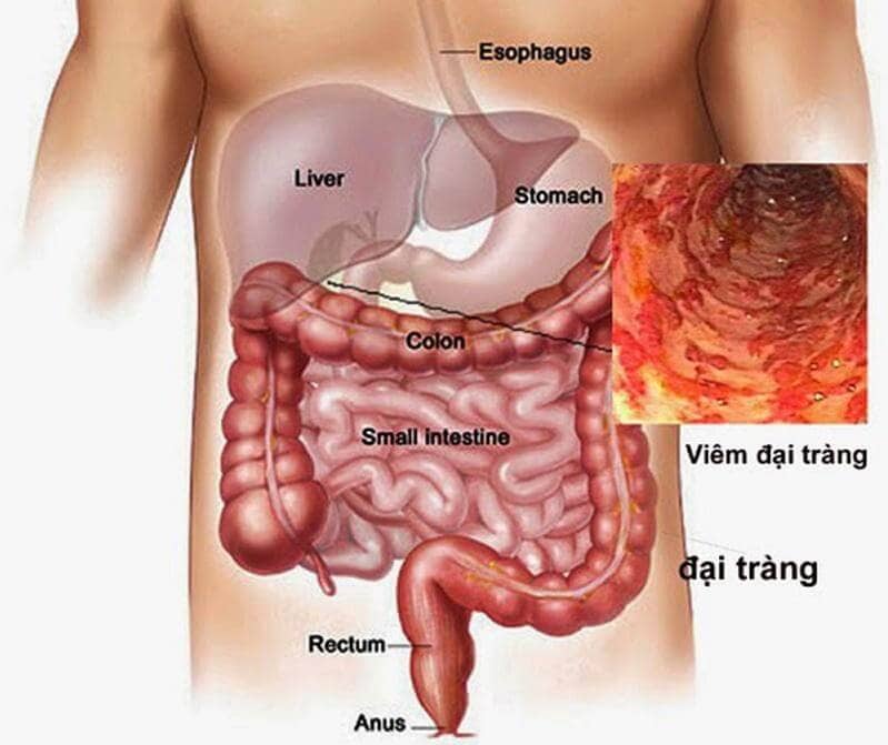 Tác dụng nấm linh chi với bệnh đại tràng co thắt