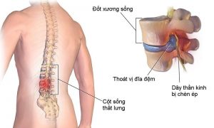 Tác dụng nấm linh chi với bệnh thoát vị đĩa đệm