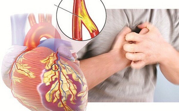 Suy tim cũng là một biểu hiện co thắt mạch