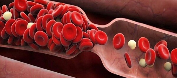 Co thắt mạch máu gây nhiều biến chứng nguy hiểm