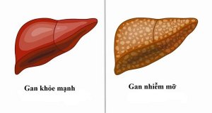 Gan nhiễm mỡ là nguyên nhân tiềm ẩn của nhiều căn bệnh về gan nguy hiểm