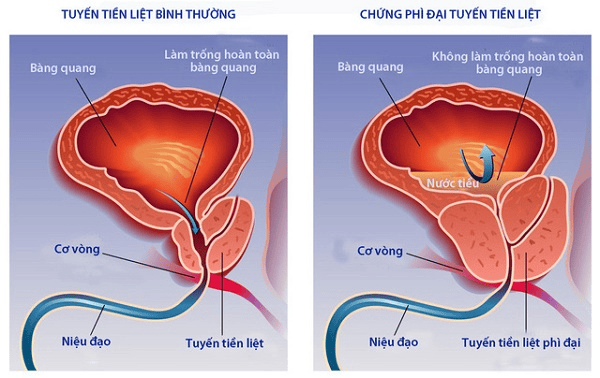 Đông trùng hạ thảo với bệnh tiền liệt tuyến