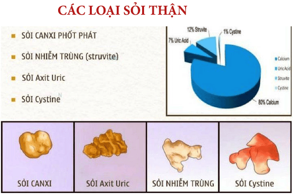 người bị sỏi thận có nên dùng đông trùng hạ thảo