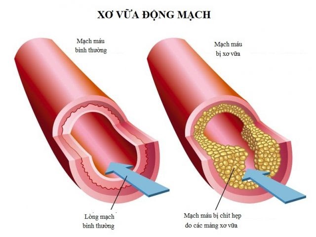 Tác dụng của đông trùng hạ thảo với bệnh xơ vữa động mạch