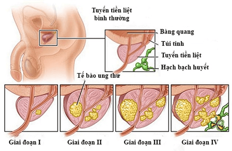 Tác dụng đông trùng hạ thảo hỗ trợ bệnh tiền liệt tuyến