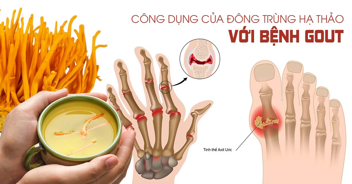 Đông Trùng Hạ Thảo hỗ trợ điều trị bệnh Gout an toàn 2022