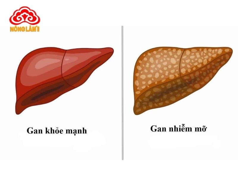 Tác Dụng Của Nấm Lim Xanh Với Bệnh Gan Nhiễm Mỡ 12 Bệnh nhân gan nhiễm mỡ