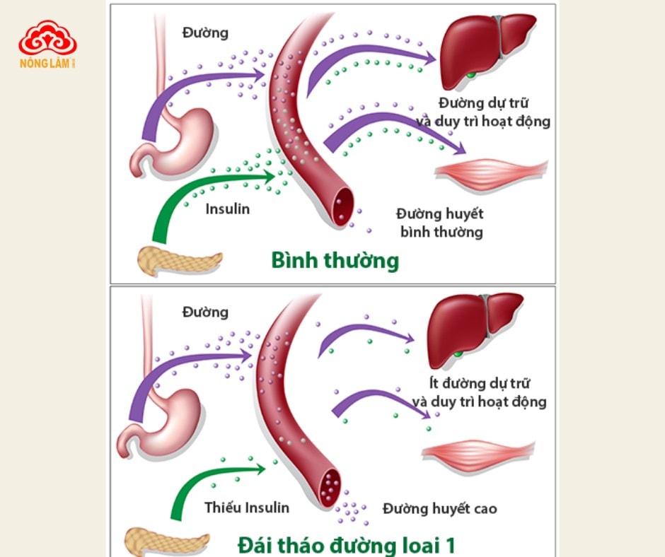 Nguyên nhân bị tiểu đường