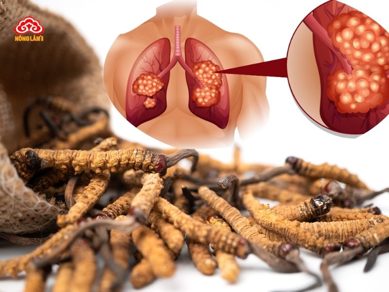 Người Bị Ung Phổi Có Dùng Đông Trùng Hạ Thảo Được Không? 8 Lợi ích của đông trùng hạ thảo với bệnh ung thư phổi