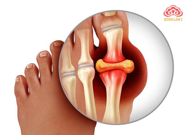 bị gout có nên dùng đồng trùng hạ thảo