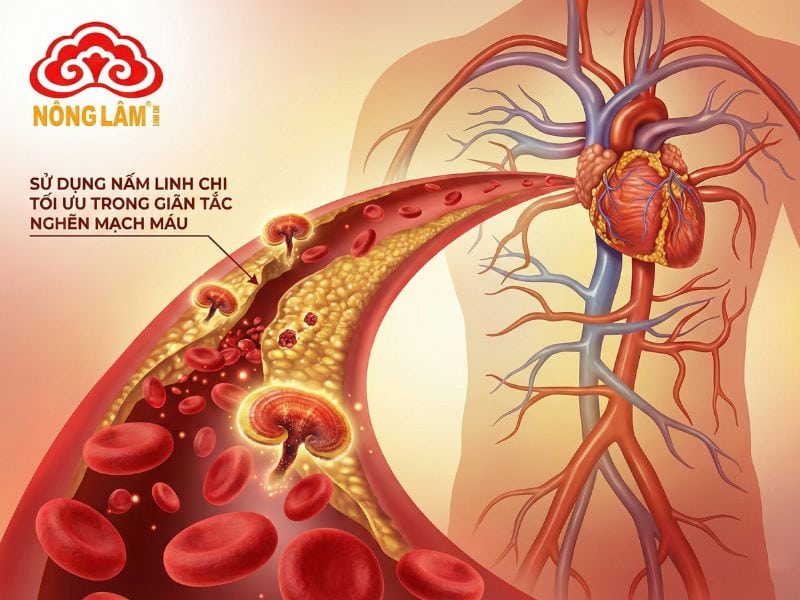 Dùng Nấm Linh Chi Để Làm Giãn Tắc Nghẽn Mạch Máu Trong Điều Trị Bệnh 6 Sử dụng nấm linh chi tắc nghẽn mạch máu