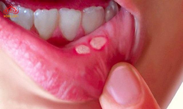 Nấm Linh Chi Trị Nhiệt Miệng: Công Dụng, Cơ Chế và Cách Dùng 7 nhiệt miệng