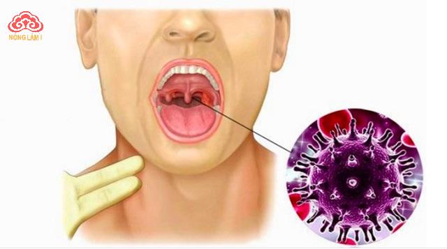Bệnh Ung Thư Vòm Họng: Nguyên Nhân, Cách Điều Trị & Phòng Ngừa 8 Bệnh Ung Thư Vòm Họng: Nguyên Nhân, Cách Điều Trị & Phòng Ngừa 6