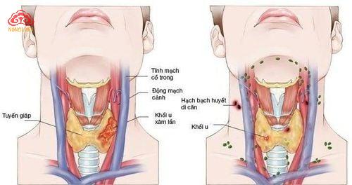 Bệnh Ung Thư Vòm Họng: Nguyên Nhân, Cách Điều Trị & Phòng Ngừa 6 Bệnh Ung Thư Vòm Họng: Nguyên Nhân, Cách Điều Trị & Phòng Ngừa 4