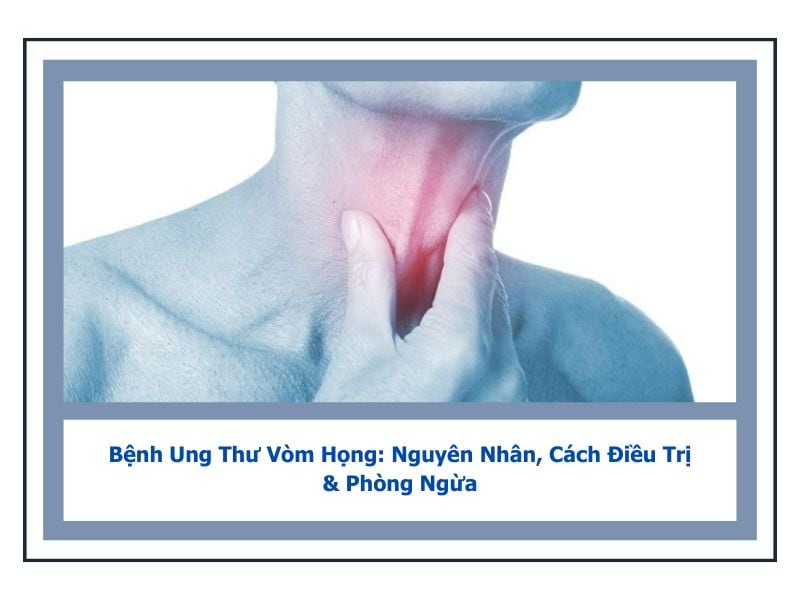 Bệnh Ung Thư Vòm Họng: Nguyên Nhân, Cách Điều Trị & Phòng Ngừa 5 bệnh ung thư vòm họng