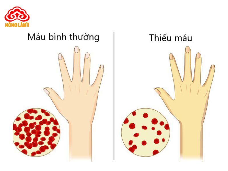 Nấm Lim Xanh - Thảo Dược Tốt Cho Người Thiếu Máu 12 Bệnh thiếu máu