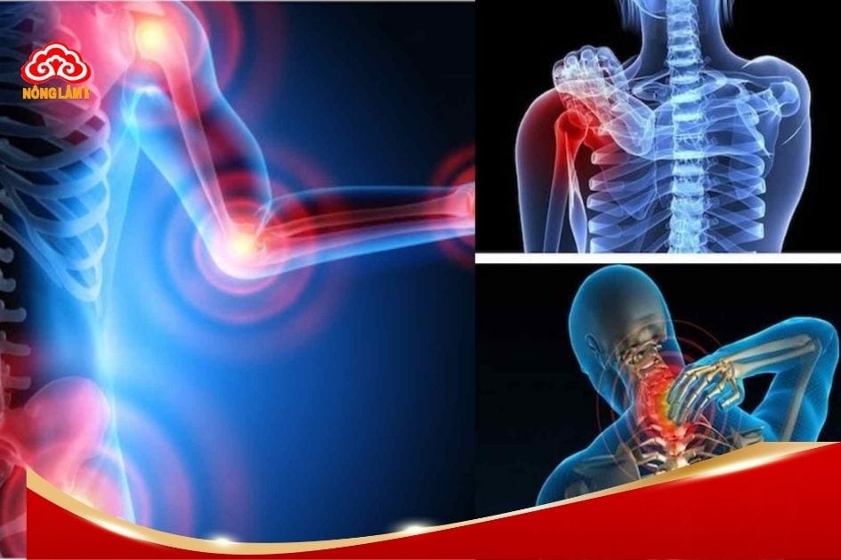 Bệnh viêm khớp (Arthritis) là một thuật ngữ chung dùng để chỉ các rối loạn ảnh hưởng đến khớp xương