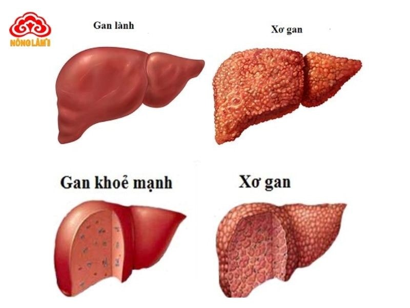 Xơ Gan: Nguyên Nhân, Triệu Chứng, Chẩn Đoán Và Điều Trị 8 Xơ gan
