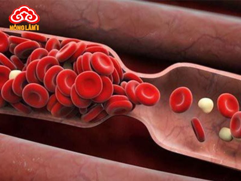 Tác Dụng Hoạt Huyết Của Nấm Linh Chi 10 Huyết ứ kéo dài sẽ làm tăng nguy cơ hình thành cục máu đông