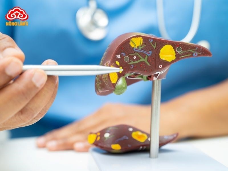 Xơ Gan: Nguyên Nhân, Triệu Chứng, Chẩn Đoán Và Điều Trị 11 Chẩn đoán bệnh xơ gan
