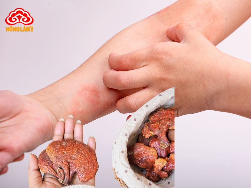 Nấm linh giúp giảm các triệu chứng khó chịu của viêm da dị ứng