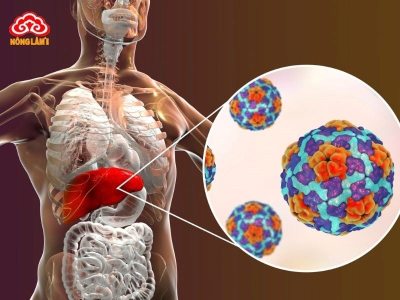 Xơ Gan: Nguyên Nhân, Triệu Chứng, Chẩn Đoán Và Điều Trị 9 Viêm gan virus mạn tính: đây là nguyên nhân hàng đầu gây xơ gan tại việt nam