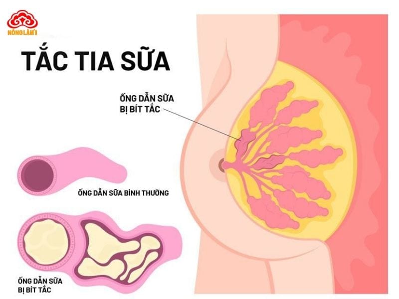 Top 3 Bài Thuốc Nấm Linh Chi Giúp Sữa Mẹ Về Nhanh 7 Hiểu về tình trạng mất sữa, tắc sữa