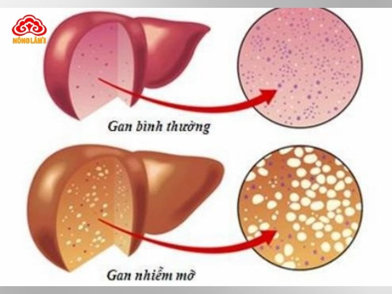 Bệnh gan nhiễm mỡ