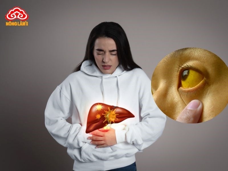 Xơ Gan: Nguyên Nhân, Triệu Chứng, Chẩn Đoán Và Điều Trị 10 Triệu chứng của bệnh xơ gan