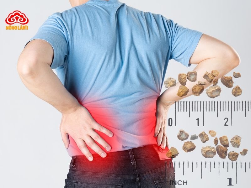 Sỏi thận gây ra các cơn đau quặn thận