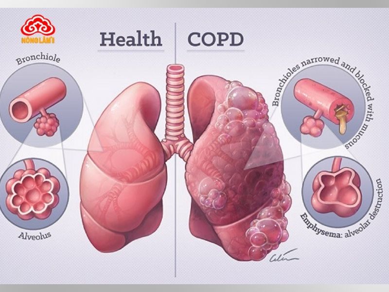 Đông Trùng Hạ Thảo Với Bệnh Copd (Phổi Tắc Nghẽn Mạn Tính) 8 Bệnh copd (phổi tắc nghẽn mãn tính)