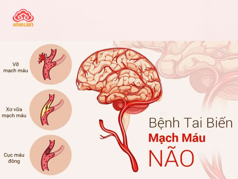 Nấm Linh Chi Hỗ Trợ Phục Hồi Sau Tai Biến Mạch Máu Não 12 Nguyên nhân tai biến mạch máu não