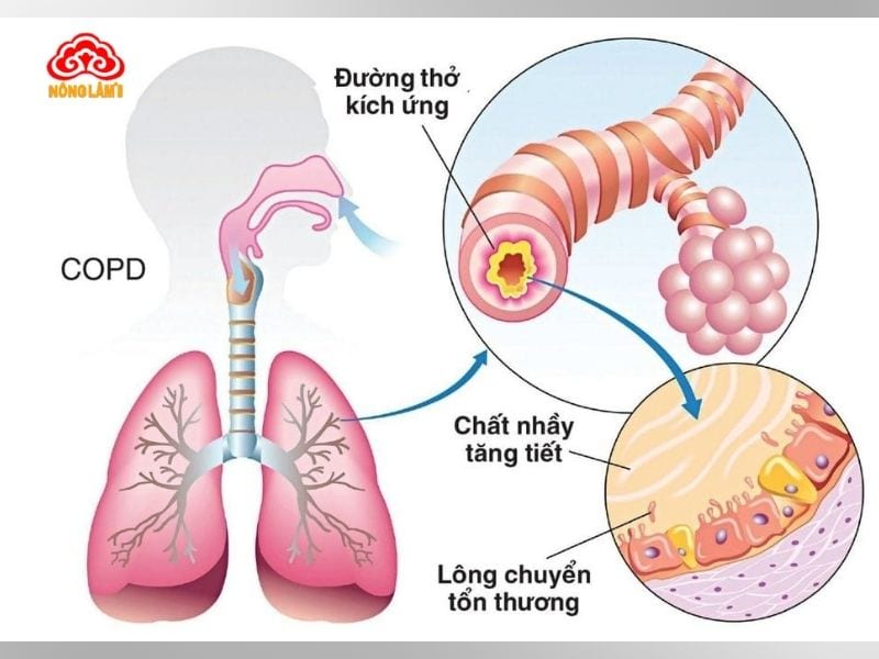 Đông Trùng Hạ Thảo Với Bệnh Copd (Phổi Tắc Nghẽn Mạn Tính) 9 Biến chứng copd nguy hiễm