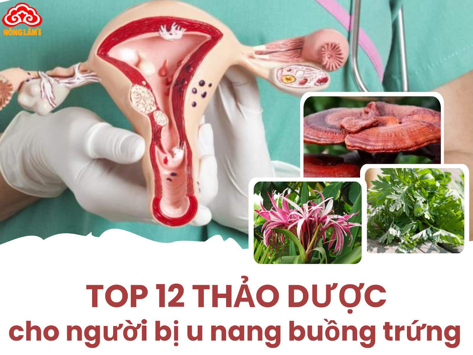 Thảo dược tốt cho bệnh u nang buồng trứng