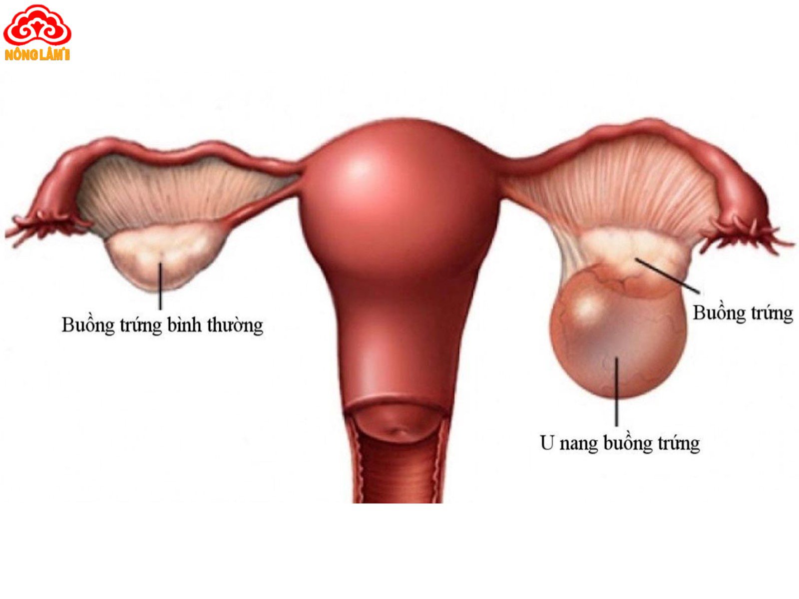 U nang buồng trứng là một tình trạng phổ biến ở phụ nữ