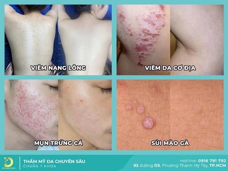 6 Phòng Khám Da Liễu Ở Tây Ninh An Toàn, Chuẩn Y Khoa 16 Hình ảnh điều trị mụn, viêm da tại dr choice