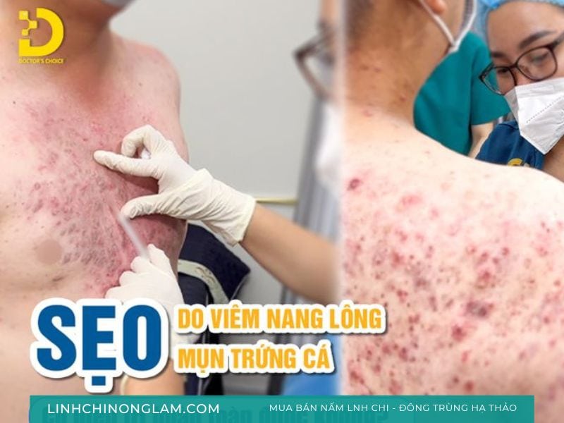 6 Phòng Khám Da Liễu Tại Long An Uy Tín, Chi Phí Hợp Lý 16 Hình ảnh điều trị mụn, sẹo tại dr choice